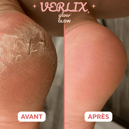 Verlix HoneyBalm™ – Baume Réparateur pour Pieds Secs & Talons Abîmés