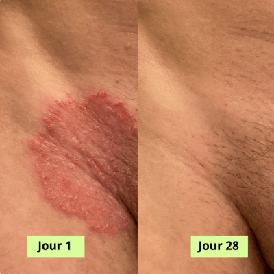 Verlix® Savon Purifiant Antifongique