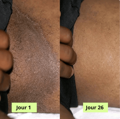 Verlix® Savon Purifiant Antifongique