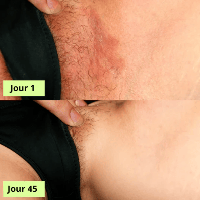 Verlix® Savon Purifiant Antifongique