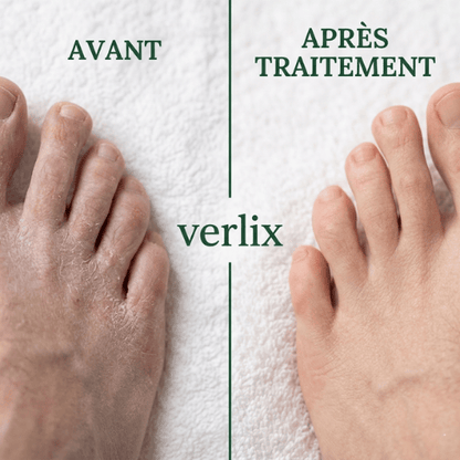 Verlix® Savon Purifiant Antifongique